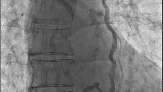 2017128 Chronic total occlusion in left subclavian vein [upl. by Norehc829]