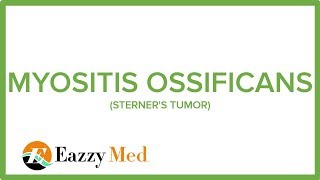 MYOSITIS OSSIFICANS STERNERS TUMOR [upl. by Dena237]