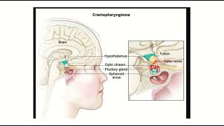 Craniopharyngioma visual field defect MRCS question solve CRACK MRCS [upl. by Aitnahs]