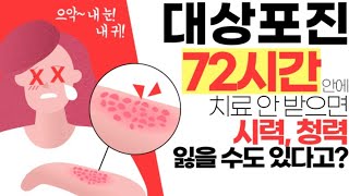 통증의 왕 대상포진 이런 증상 나타나면 반드시 의심하세요 [upl. by Namqul20]