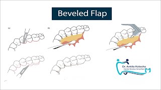 BEVELED FLAP PERIODONTAL FLAP SURGERY ON PALATAL ASPECT MODIFICATION OF APICALLY REPOSITIONED FLAP [upl. by Elgar]