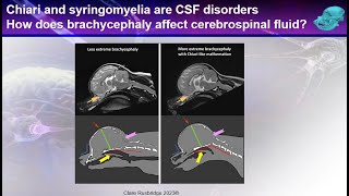 Syringomyelia from the expert  the filling mechanism [upl. by Julita]