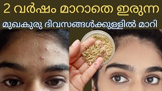 In just a few Days Remove pimples amp dark spots in Malayalamകളിയാക്കുന്നത് കേട്ട് മടുത്തു 🥺 [upl. by Relyk358]