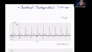 Quick Junctional Rhythms Review Paramedic Cardiology [upl. by Aracahs740]