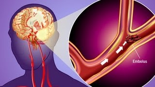 Stroke Prevention amp Transient Ischemic Attack TIA [upl. by Laerdna]