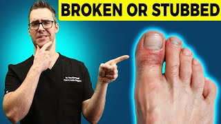 Stubbed Toe or Broken Toe Symptoms Pain Relief amp Treatment [upl. by Dworman486]