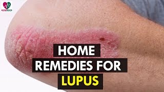 Home Remedies for Lupus  Health Sutra [upl. by Sakhuja]