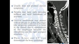 Diffuse Idiopathic Skeletal Hyperostosis DISH [upl. by Neela671]