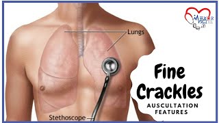 Fine Crackles  Lung Sounds  Auscultation Features [upl. by Enila924]