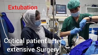 Extubation how to extubate critical patient after extensive Surgery without complications [upl. by Ancier]