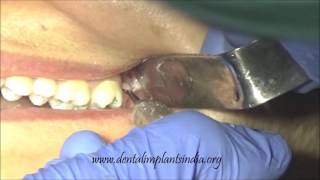 Deeply impacted upper wisdom molar surgical removal video [upl. by Dusty267]