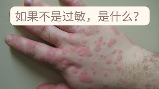 Erythema Multiforme：很像过敏的一种皮肤红疹。如何区别诊断，如何治疗，多久能好？ [upl. by Werbel]