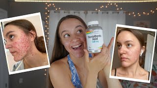 I TOOK PANTOTHENIC ACID FOR 2 MONTHS  Pantothenic Acid B5 For Acne [upl. by Portland]