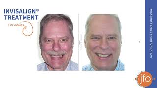 LifeChanging Invisalign Treatment for Adults  Joosse Family Orthodontics  Williamsburg VA [upl. by Ingelbert]