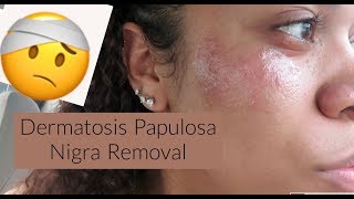 I had my dermatosis papulosa nigra removed [upl. by Bilski931]