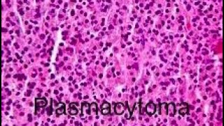 Getting closer to Pathology exams Plasmacytoma [upl. by Midge]