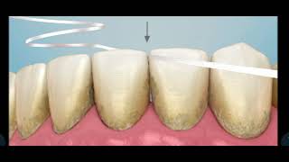 Interdental cleaning 🧹 with floss animation [upl. by Karie]