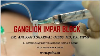 GANGLION IMPAR BLOCK [upl. by Selway]