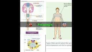 Paraplegia [upl. by Yngad414]