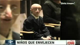 Un joven con progeria muere a los 17 años [upl. by Cusack]