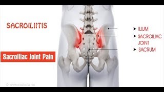 सैक्रोइलिइटिस  Sacroiliitis PAIN  कारण लक्षण और निदान एवं लाभदायक योग [upl. by Drapehs692]