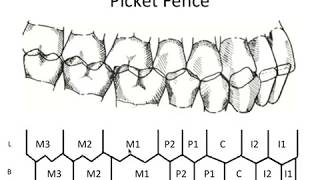 STATIC OCCLUSION  Occlusal Contacts amp Picket Fence [upl. by Manvel19]