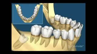 Dents de Sagesse  Tous les différents cas dextraction [upl. by Arutak]