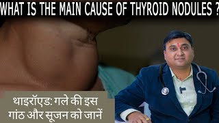 Thyroid Nodules थायरॉइड ग्रंथि में गांठ या गांठ की असामान्य वृद्धि [upl. by Ellenid724]