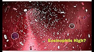 Eosinophils High Low – Causes [upl. by Standush]