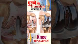 Knee Joint Transplant  घुटने कैसे बदले जाते हैं । Knee replacement viral shorts [upl. by Bellaude79]