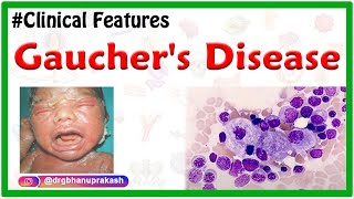 Gauchers Disease Etiology Types Clinical Features Pathogenesis Diagnosis and Treatment [upl. by Groveman979]