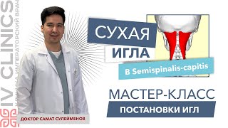 Сухая игла в SEMISPINALIS CAPITIS Полуостистая мышца  Мастеркласс постановки сухой иглы [upl. by Patin674]