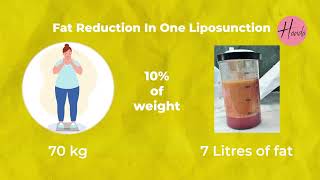 The Truth About Liposuction Myths amp Facts [upl. by Jurdi94]