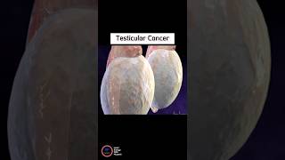 Testicular Cancer [upl. by Iatnahs]