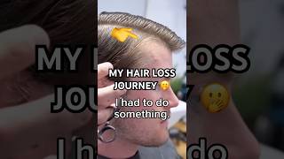 Best hair loss transformation [upl. by Asertal]