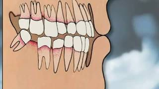 Dental Implants Pros amp Cons  YOU MUST SEE IT [upl. by Nabla599]