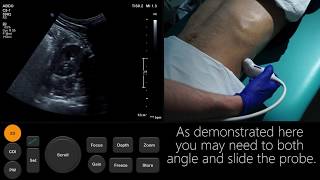 Ultrasound Tutorial Kidney amp Bladder  Urinary Tract  Radiology Nation [upl. by Ailen]