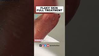 Flaky Skin full Treatment by Miss Foot Fixer [upl. by Ellenaej]