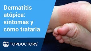 Tratamiento recomendado para la dermatitis atópica 55 [upl. by Origra173]