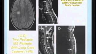 Neuromyelitis Optica and the concept of Autoimmune Aquaporin4 Channelopathy [upl. by Cate]