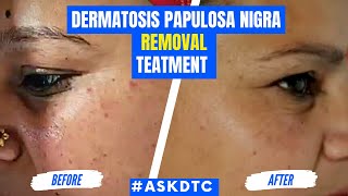 Dermatosis Papulosa Nigra Condition Treatment  Dr Rohit Goel [upl. by Eilyac353]