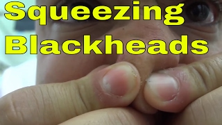 DIYSqueezing Blackheads Out Of My NoseQUICK And EASY [upl. by Ahsiekel]