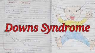 Downs Syndrome  Trisomy 21  Mongolism  Notes With Diagrams To Understand Better  Cx and Features [upl. by Orten]