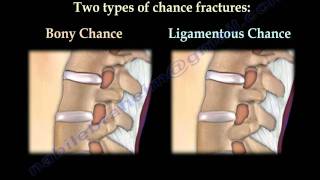 Chance Fractures of the Spine  Everything You Need To Know  Dr Nabil Ebraheim [upl. by Novia]