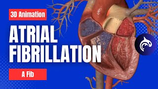 Atrial Fibrillation AFib  3D Animation [upl. by Eenat]