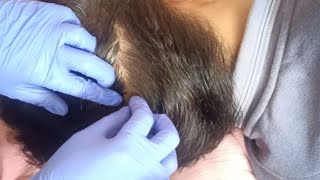 ASMR Scalp Check With Gloves [upl. by Nonregla]