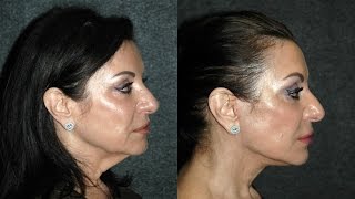 Lower Facelift Without Anesthesia lowerfacelift [upl. by Leirbag873]