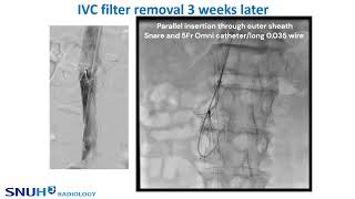 2023 IVC filter removal case Loop snare technique [upl. by Lou]