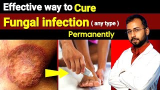 Best antifungal cream for fungal infection  ringworm  how to get ride of fungal infection [upl. by Lareine628]