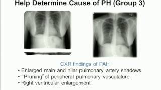 Pulmonary Hypertension Improving Diagnosis [upl. by Sirtimed]